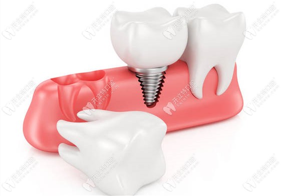 种植牙市场价格,历史背景与现代变迁的影响分析