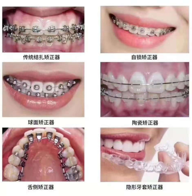 隐形牙套价格揭秘，背后的甜蜜故事启程篇章