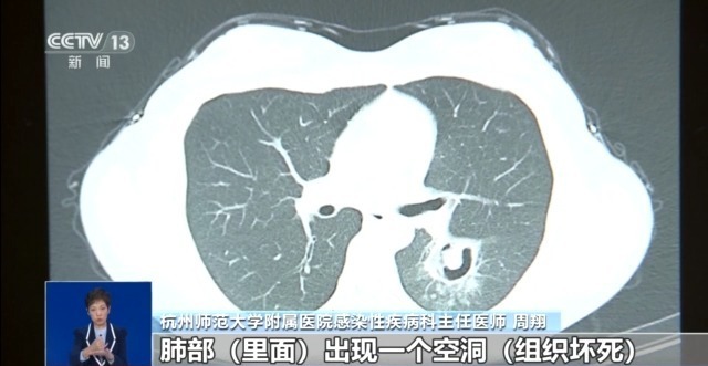肺炎最新治愈进展，时代进步的见证者